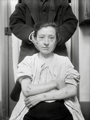 Charles Lhermitte [1881-1945] Folles de la Salpêtrière Négatifs au gélatino-bromure d’argent sur verre Vers 1910 Collection du musée Nicéphore Niépce