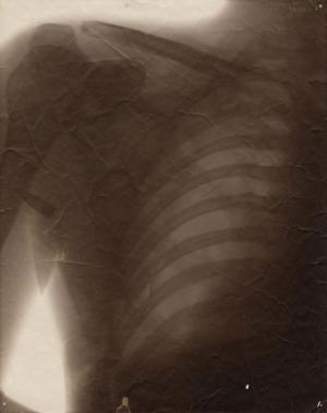 Anonyme Radiographie d'une cage thoracique ayant reçu une balle (que l'on distingue sous l'aisselle) lors de la guerre 1914-18. Collection musée Nicéphore Niépce 