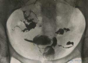 6.	Radiographie d’un bassin, 1951, tirage argentique, Don anonyme © musée Nicéphore Niépce 